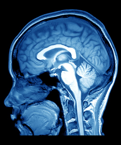 Ectrims: rallentare l’atrofia corticale ritarda la Sm clinicamente definita
